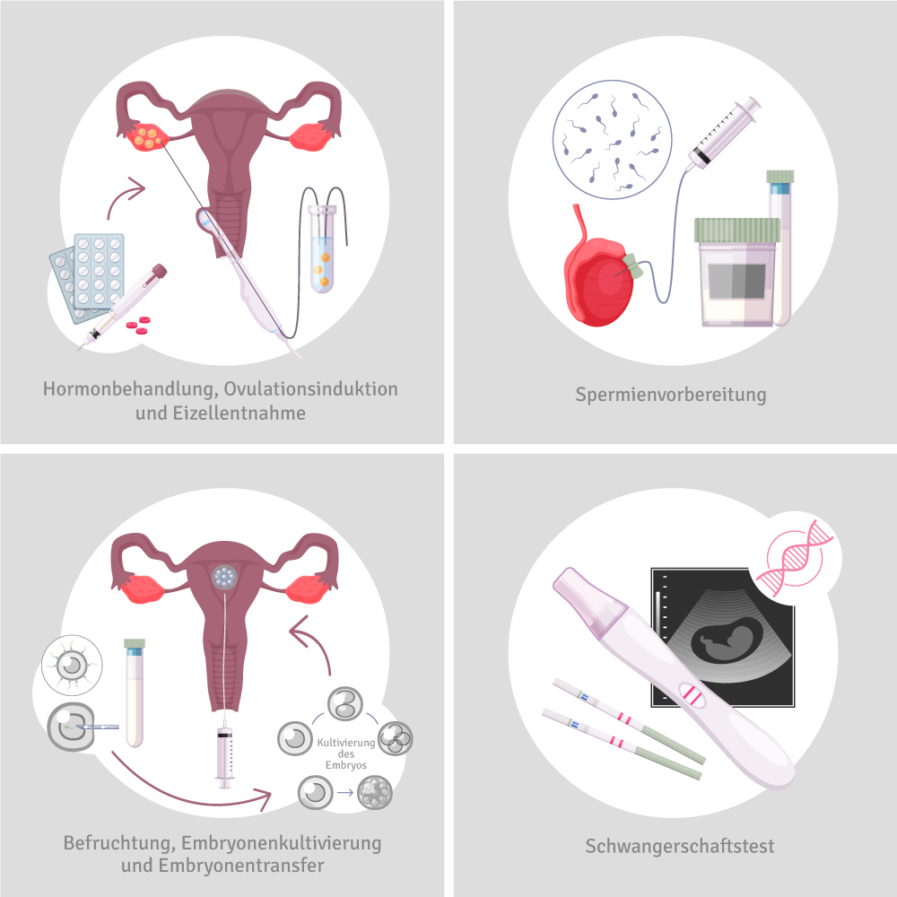 IVF-Grafik