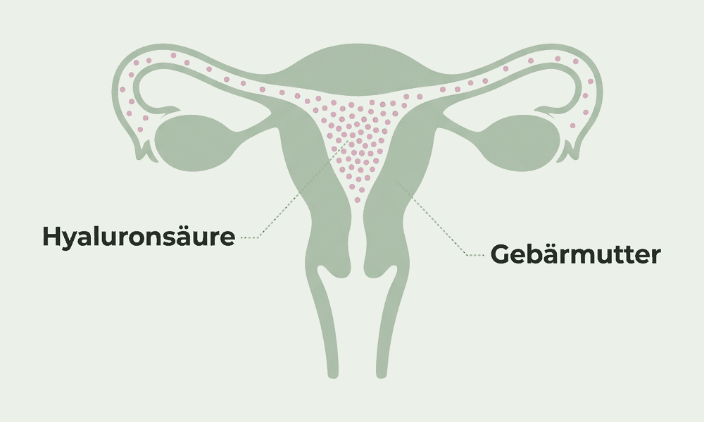Gebärmutter und Eileiter im Schema, Hyaluronsäure als Punkte, am dichtesten in der Gebärmutterhöhle