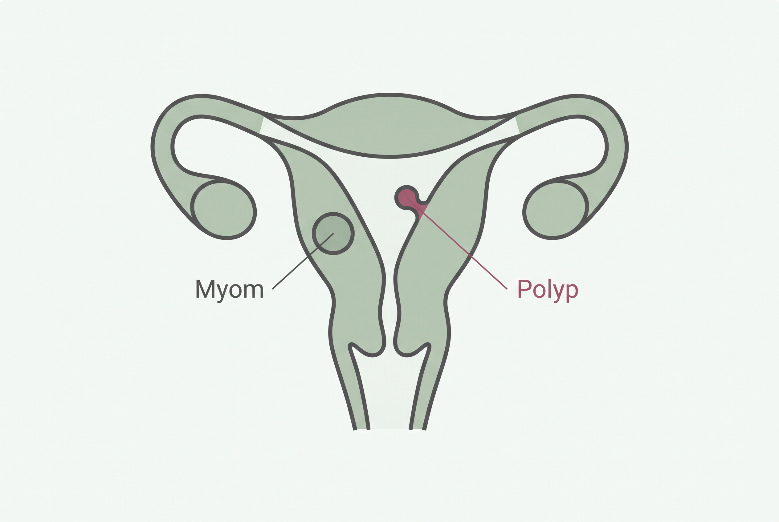 Schema einer Gebärmutter mit einem Myom in der Wand und einem Polypen in der Gebärmutterhöhle