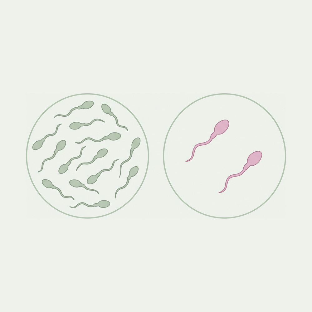 Zwei Sichtfelder im Vergleich, im linken viele Spermien, im rechten zwei, Illustration der Kinderwunschklinik Dr. Pavlik